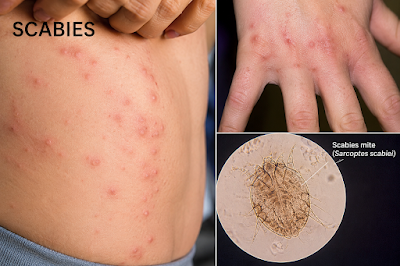 Clinical Presentation of Scabies Infestation A dermatological view of localized skin irritation and small tracks on a patient's hand caused by scabies.