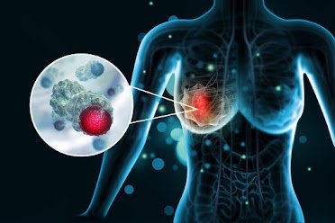 Breast Cancer: Symptoms, Causes, and Prevention Medical illustration showing breast cancer awareness, symptoms, and prevention information.