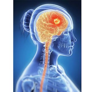 brain-cancer-awareness.jpg Medical illustration showing brain cancer and tumor awareness